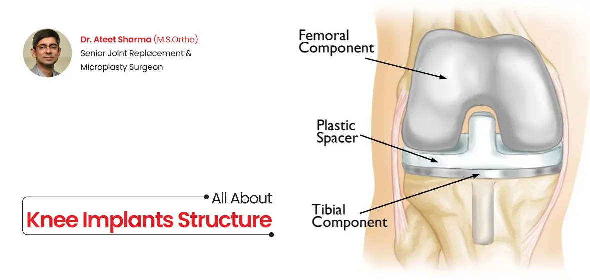 all about knee implants structure