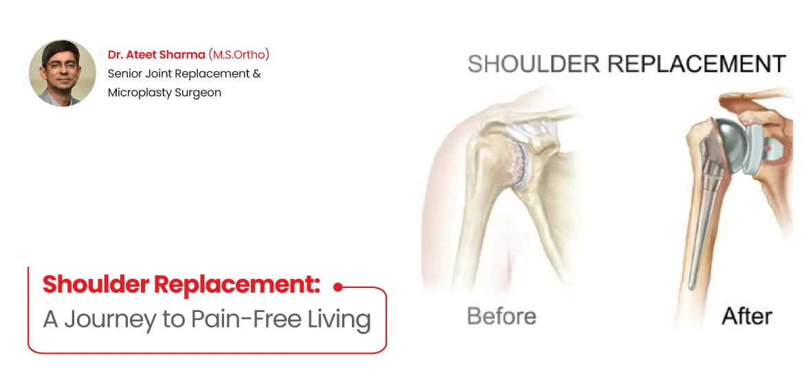 shoulder replacement