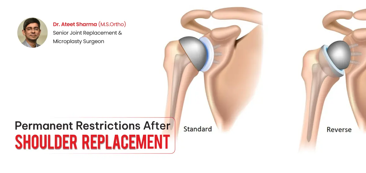 what to expect after knee replacement