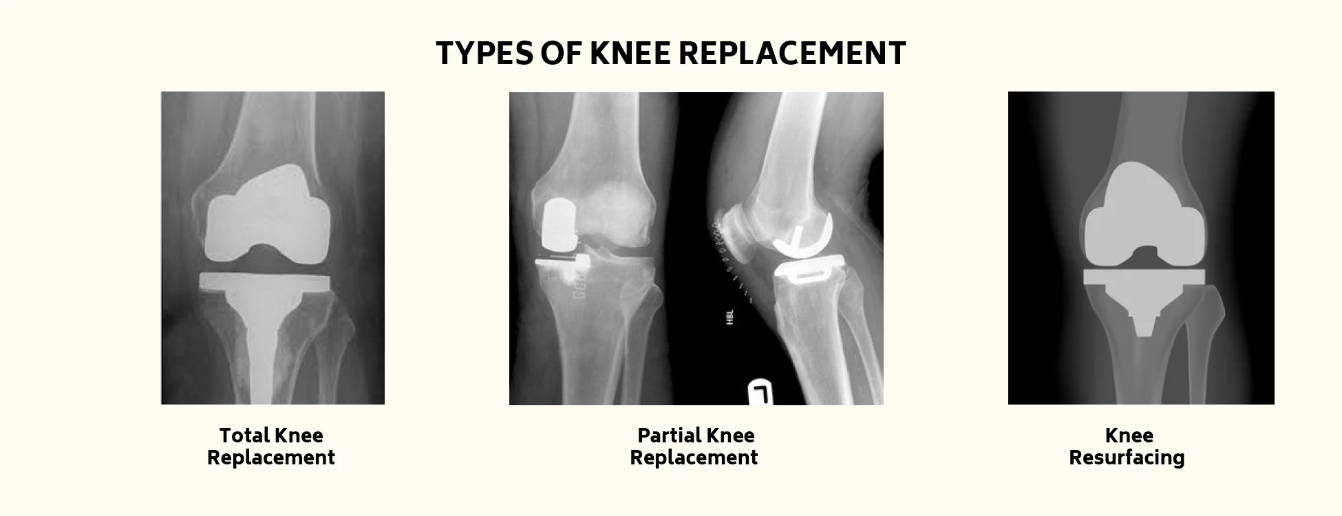 Hip Replacement Treatment