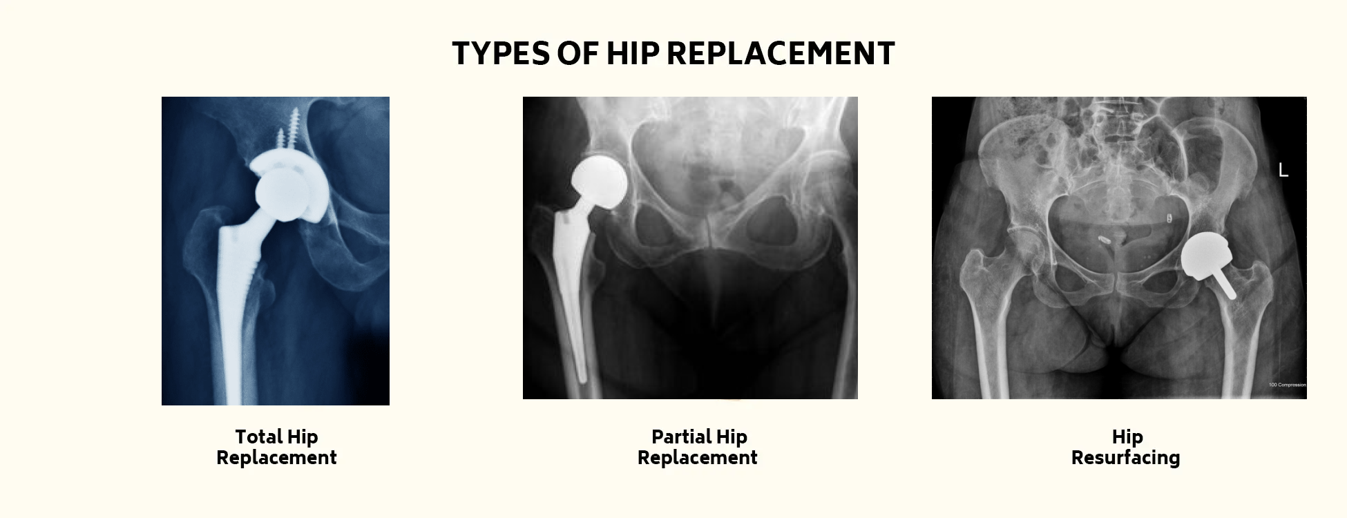 Hip Replacement Treatment