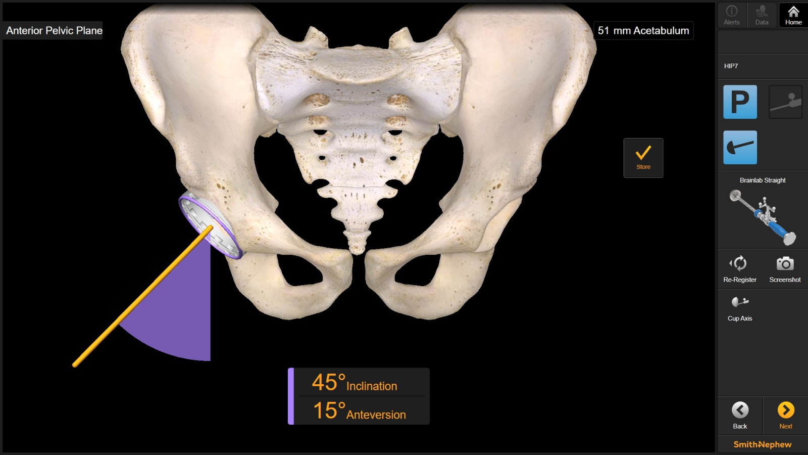 Hip Replacement Treatment