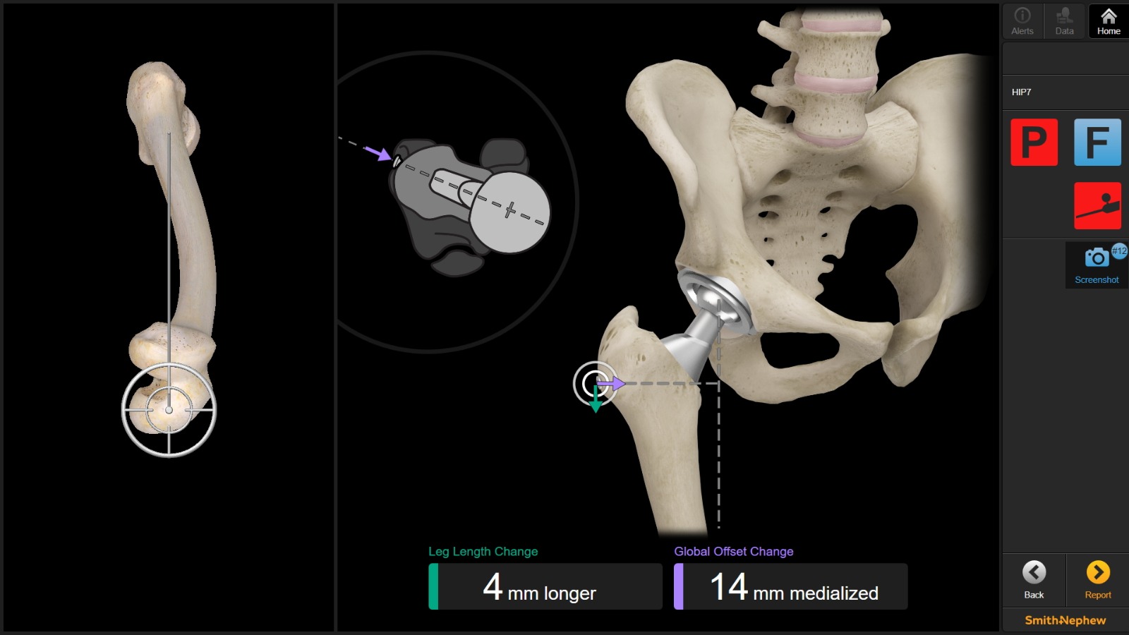 Hip Replacement Treatment