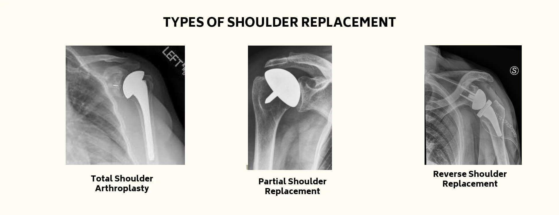 Hip Replacement Treatment